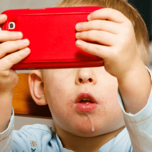 Excessive drooling is a common symptom in young children diagnosed with childhood dysarthria condition
