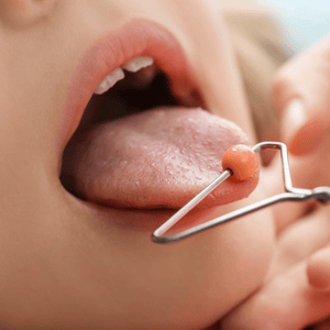 Strengthening tongue muscles through targeted therapy supports improved speech in childhood dysarthria treatment plans